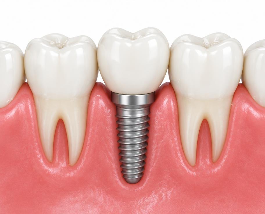 Dental Implants